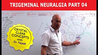 Trigeminal Neuralgia  Causes and Treatment  Part 4 [upl. by Schaefer227]