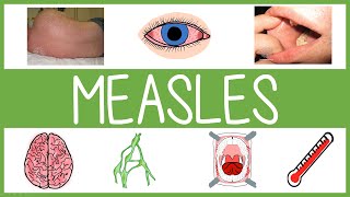 Measles  Features Management and Mnemonics [upl. by Nnyrat254]