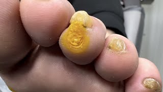 Removal of Multiple Warts and Calluses [upl. by Durkee]