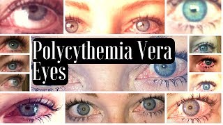 MPN Polycythemia Vera Blood Shot Red Eye Manifestations [upl. by Anail278]