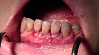 Emdogain Surgical Revision of Previous Alloderm Gingival Grafting Surgery 2520 PF [upl. by Ariom91]