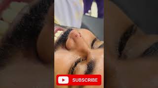 Laser Mole Removal  Mole तिल kaise nikale shortvideo viral doctor hospital skincare mole [upl. by Mcnair]