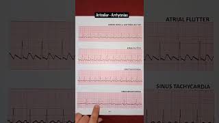 ECG Rhythms EKG ecg ekg electrocardiogram interpretation [upl. by Dorcas]