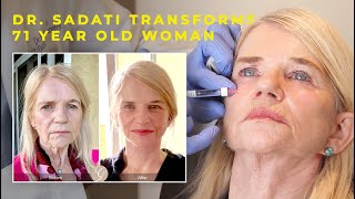 Dr Sadati Transforms 71 year old Woman with Lower Face and Neck Lift and Restylane Lyft Filler [upl. by Aleunamme]