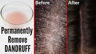 How to cure dandruff permanently naturally at home [upl. by Honor]