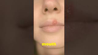 “Quick Tips To Manage Mouth Ulcers “ [upl. by Allix664]