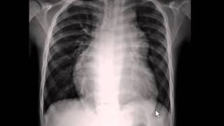 Chest xray  pulmonary arterial hypertension [upl. by Aisat]