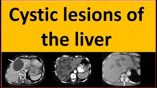 Differential diagnosis of cystic lesions of the liver [upl. by Laurin]