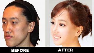 15 Korean Plastic Surgery Before amp After Photos [upl. by Ariana]