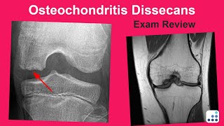 Osteochondritis Dissecans Exam Review  Mark Pagnano MD [upl. by Sheffield]