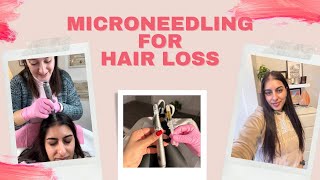 I Tried Microneedling For My Hair Loss [upl. by Plotkin855]