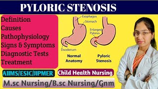 Pyloric Stenosis in Pediatric Nursing  Projectile Vomiting  Causes  Pathophysiology  Treatment [upl. by Caprice508]