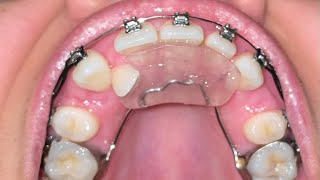 Upper Braces Time Lapse  15 Month Update  Adult Braces [upl. by Maxi]