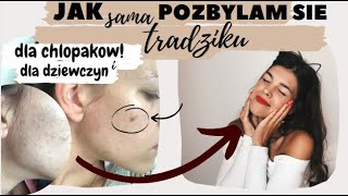 JAK SIE POZBYC TRADZIKU  TRADZIK  SPRAWDZONE SPOSOBY NA TRADZIK  JAK SZYBKO POZBYC SIE PRYSZCZA 💥 [upl. by Oinotnas11]