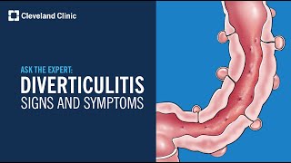 Warning Signs of Diverticulitis  Ask Cleveland Clinics Expert [upl. by Ahrendt397]