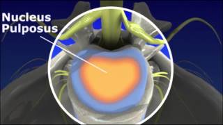 Herniated Disc  Pain Management [upl. by Notna63]