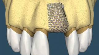 Implantes Dentários  Com Enxerto Ósseo [upl. by Keelby777]