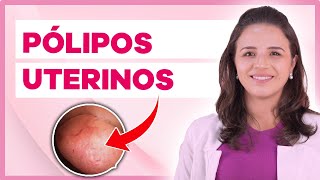 Pólipo endometrial é perigoso Vídeo com Retirada de Pólipo [upl. by Anselmi]