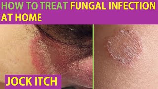 Is it ringworm Signs and symptoms  Tinea amp JOCK ITCH  HOW TO TREAT SKIN FUNGAL INFECTION [upl. by Jacqui81]