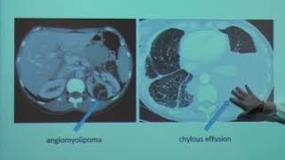 LAM Action Patients Meeting 2018  Rapamycin and LAM [upl. by Charin766]