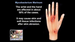 Mycobacterium Marinum  Everything You Need To Know  Dr Nabil Ebraheim [upl. by Kannry798]