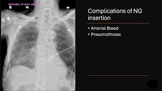 NG tube complications [upl. by Jenn]