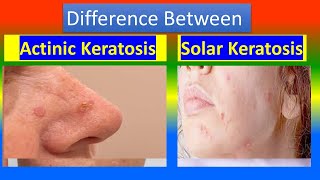 Actinic Keratosis Vs Solar Keratosis [upl. by Northrop]