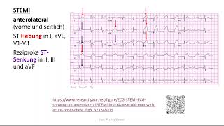 Herz 11 EKG 4  STEMI Perikarditis Extrasystole Kammerflimmern [upl. by Newra]