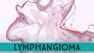 Lymphangioma Lymphatic Malformation under the microscope pathology dermpath dermatology [upl. by Ednutey]