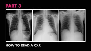 How XRays Work  How to Read a Chest XRay Part 3  MEDZCOOL [upl. by Airlee]