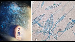 Tinea capitis bei Microsporum canis [upl. by Shurlocke]