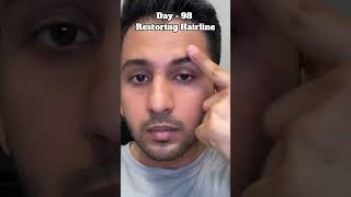 Day98 Restoring Hairline with Derma Roller  Minoxidil  Finasteride  Red Light Therapy hairloss [upl. by Arihay975]