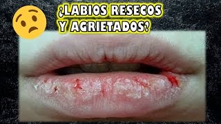 ¿LABIOS RESECOS Y AGRIETADOS  Tengo la solución [upl. by Nonohcle575]