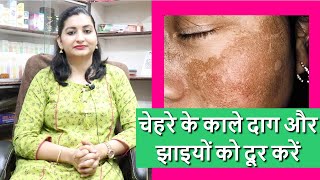 Chloasma Melasma का का पूरा ईलाज  Blemish amp Pigmentation Treatment  Face Dark Spots Kaise Hataye [upl. by Abdu]