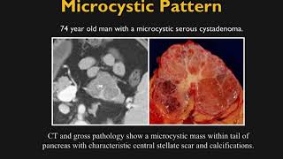 CT Evaluation of Cystic Pancreatic Masses A Systemic Approach Part 1 [upl. by Enayr]