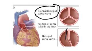 Bicuspid aortic valve [upl. by Lemrac]