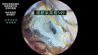 Hard cerumen embolism fungal infection ｜549 [upl. by Sallyanne]