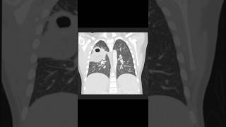 HRCT Chest Necrotizing pneumonia viralreels [upl. by Domash]