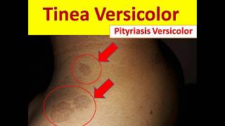 Tinea Versicolor in Young People  Pityriasis Versicolor [upl. by Ragucci300]