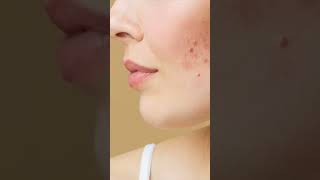 Acne cleanser  How to remove acne and pimples Best Affordable acnesoft pimplesolutionpimples [upl. by Hcirteid]