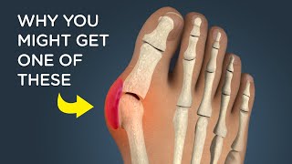 Bunions What Causes Them and How Theyre Removed [upl. by Werdma]