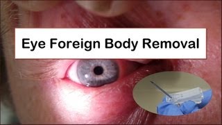 Eye Foreign Body Removal [upl. by Reh717]