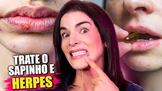 HERPES Experimente este Tratamento com um Comprimido NATURAL [upl. by Enail]