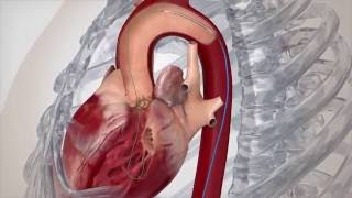 Cardiac Innovations amp Structural Heart Center  SAPIEN Transfemoral Procedure [upl. by Annawit951]