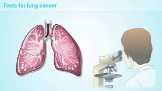 What is Lung Cancer [upl. by Jean763]