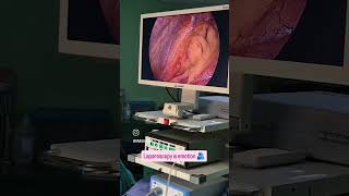 laparoscopy appendectomy [upl. by Ametaf341]