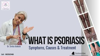 PSORIASIS VULGARIS  Information and treatment by dermatologist  Dr Smita Chakote [upl. by Jed]