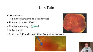 Panretinal Photocoagulation PRP Basics Lumenis Laser  BIDMC  Jamie Raevis Arroyo Gonzalez [upl. by Helm]