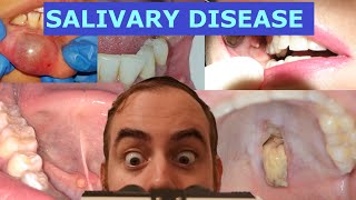 The ULTIMATE Nonneoplastic Salivary Pathology Review Video [upl. by Annaliese449]