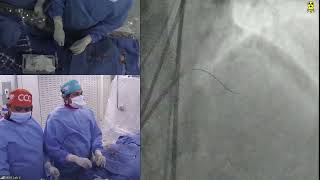 LIVE CASE 7  PCI of LAD CTO with Antegrade Wiring Technique [upl. by Michaela]